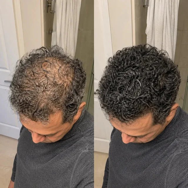 Duas vistas superiores lado a lado mostram a região da coroa em cabelo curto e cacheado.