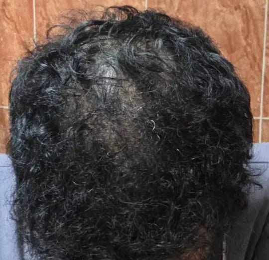 Vista superior de cabelo escuro e cacheado com a região da coroa visível.